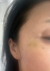 40代　ボトックス　目尻　失敗　やって良かった