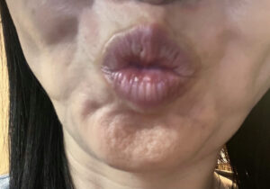 40代　ボトックス　目尻　失敗　やって良かった